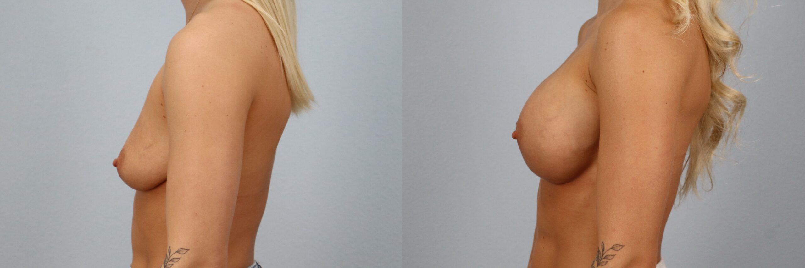 Before and after – Breast Augmentation – Female patient, age 20-29 – Image 12