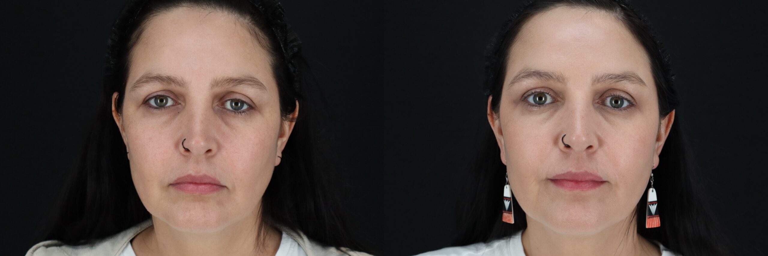 Before and after – Medi Spa – Female patient, age 40-49 – Image 23