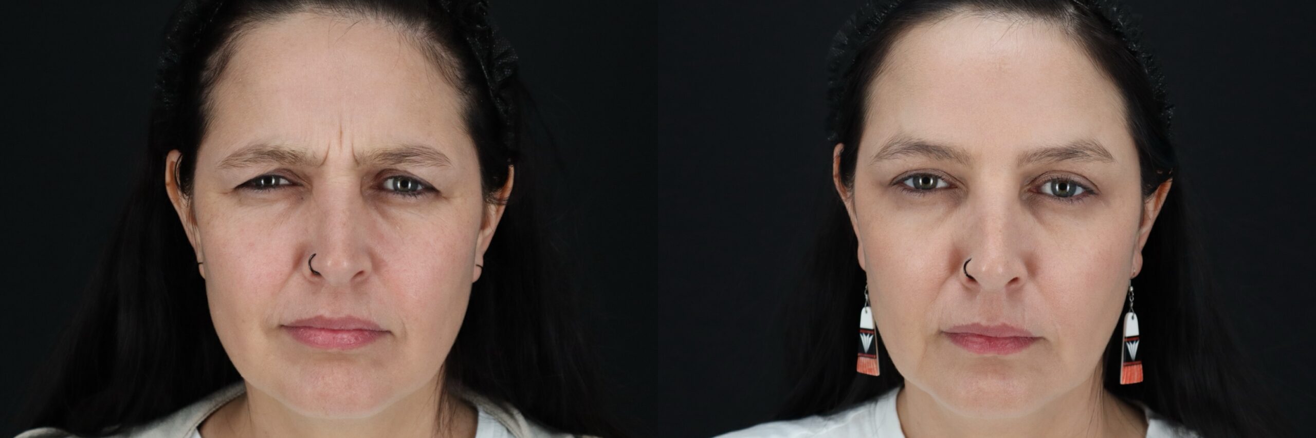 Before and after – Medi Spa – Female patient, age 40-49 – Image 25