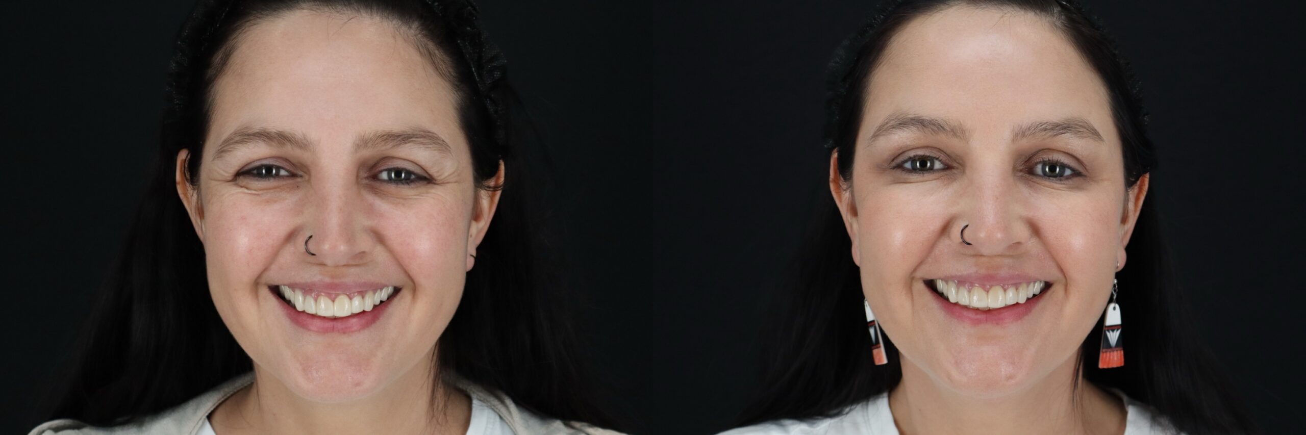 Before and after – Medi Spa – Female patient, age 40-49 – Image 24