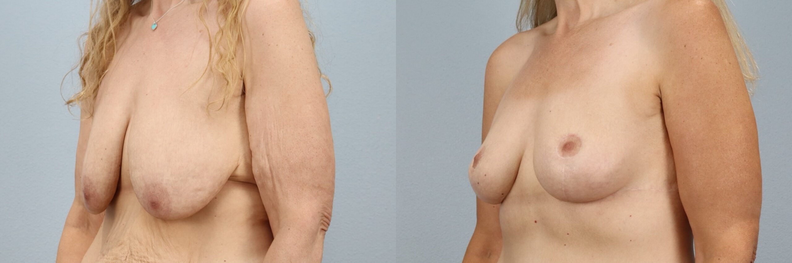 Before and after – Breast Surgery – Female patient, age 40-49 – Image 17