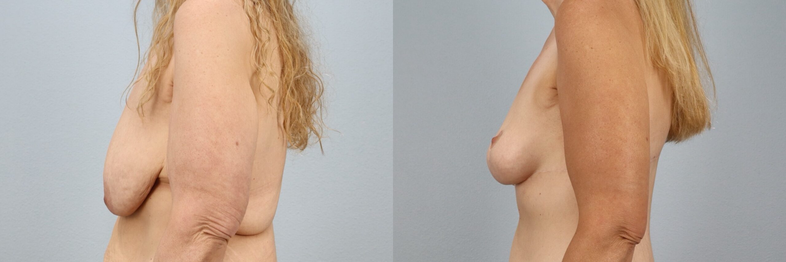 Before and after – Breast Surgery – Female patient, age 40-49 – Image 18