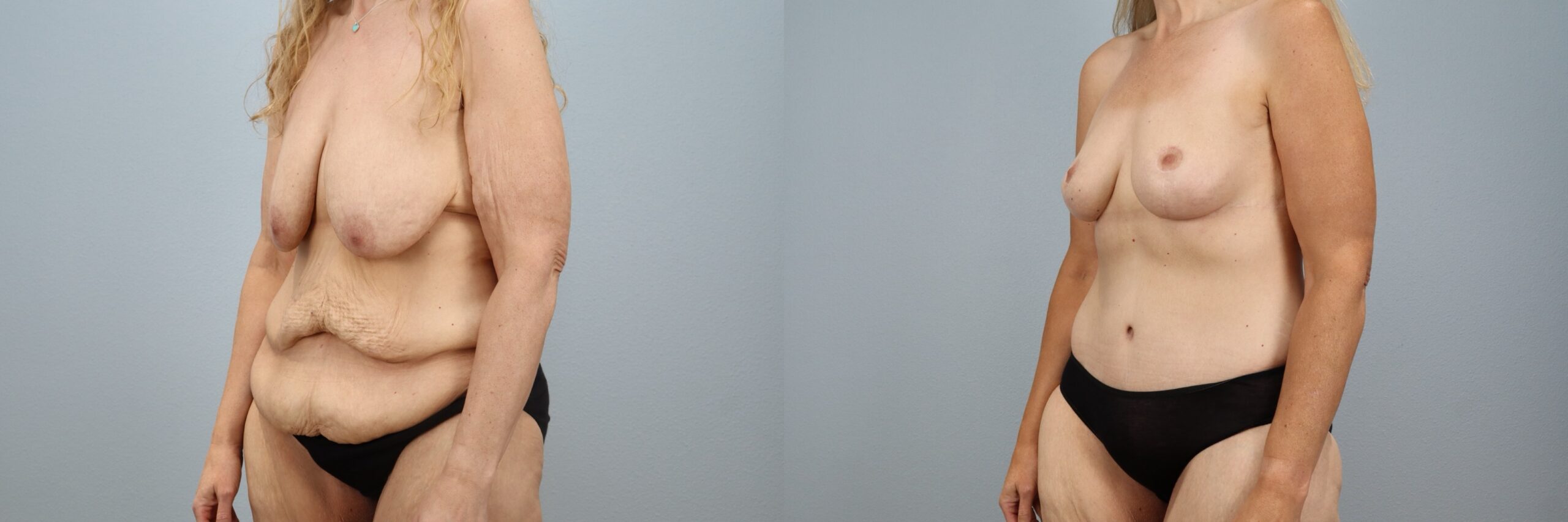 Before and after – Weight Loss Transformation – Female patient, age 40-49 – Image 26