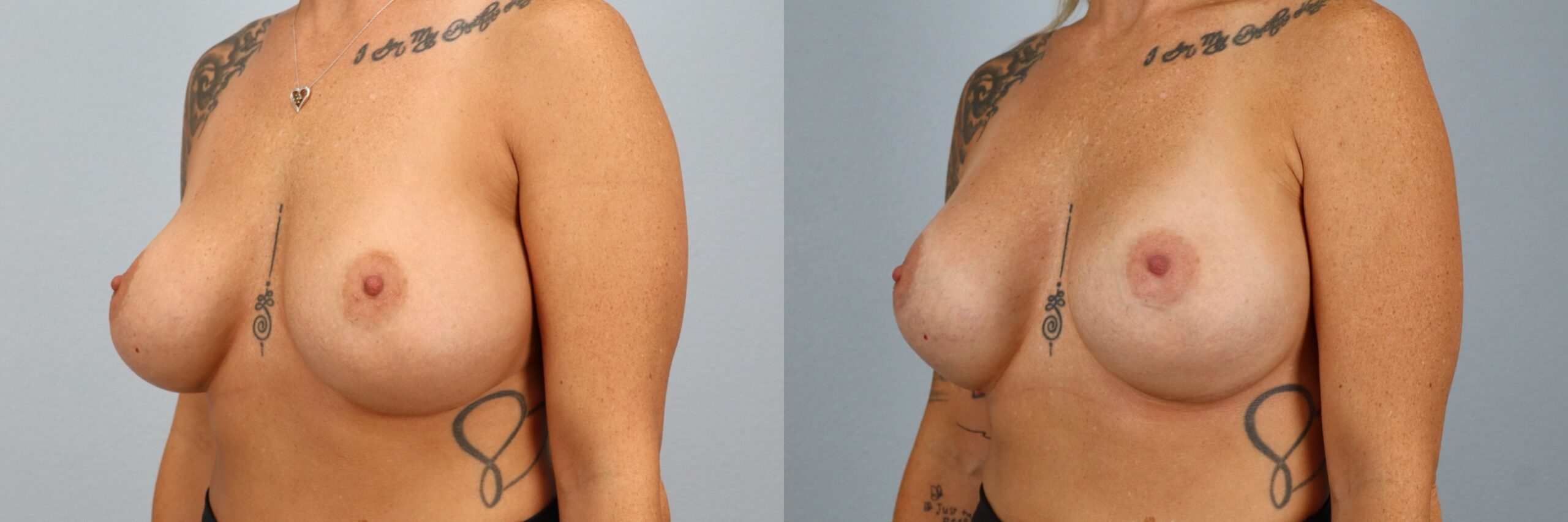 Before and after – Breast Surgery – Female patient, age 30-39 – Image 55