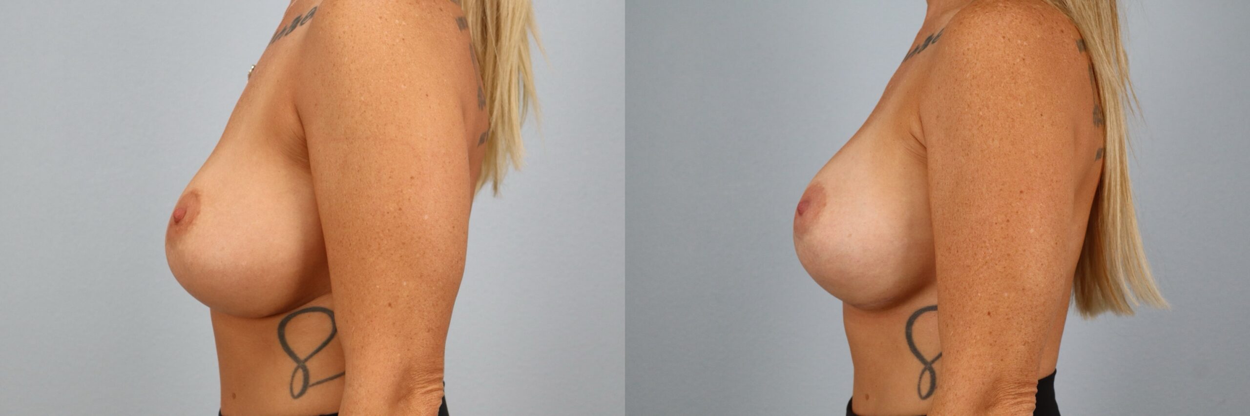 Before and after – Breast Surgery – Female patient, age 30-39 – Image 56