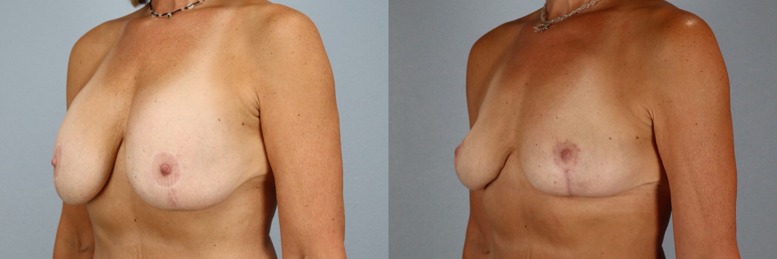 Before and after – Breast Surgery – Female patient, age 60+ – Image 17