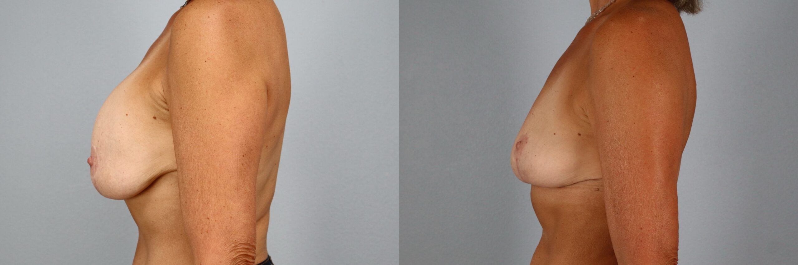 Before and after – Breast Surgery – Female patient, age 60+ – Image 18