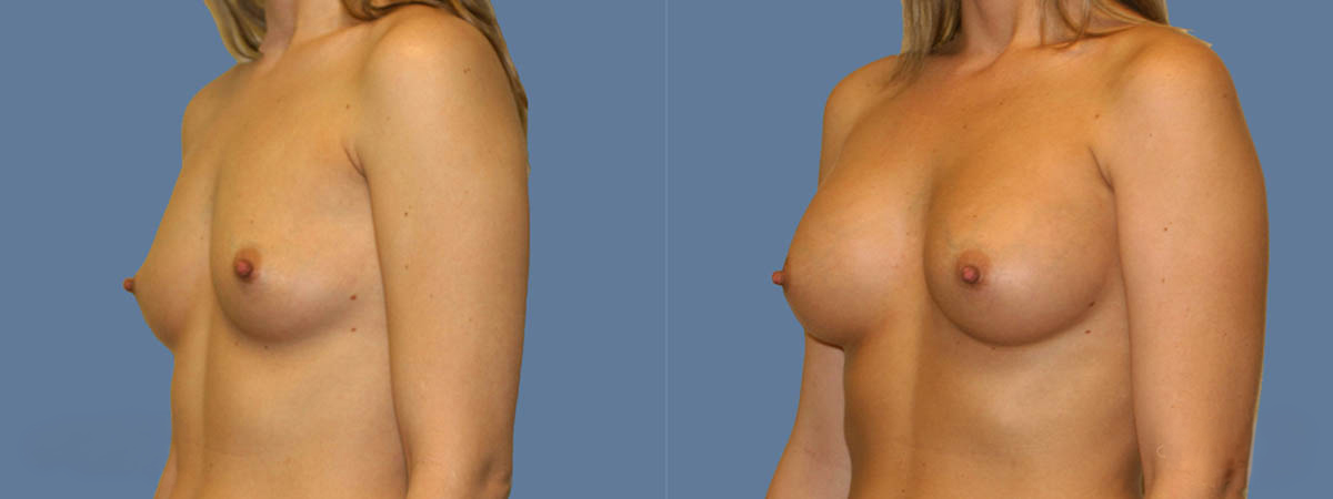 Before and after – Breast Surgery – Female patient, age 20-29 – Image 20