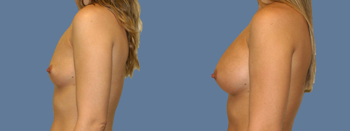 Before and after – Breast Surgery – Female patient, age 20-29 – Image 21