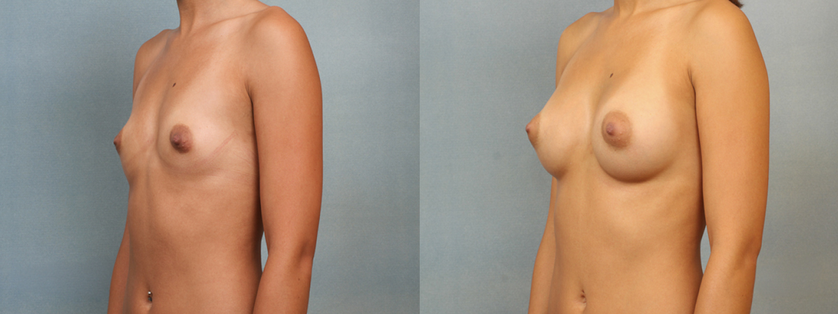 Before and after – Breast Surgery – Female patient, age 20-29 – Image 38