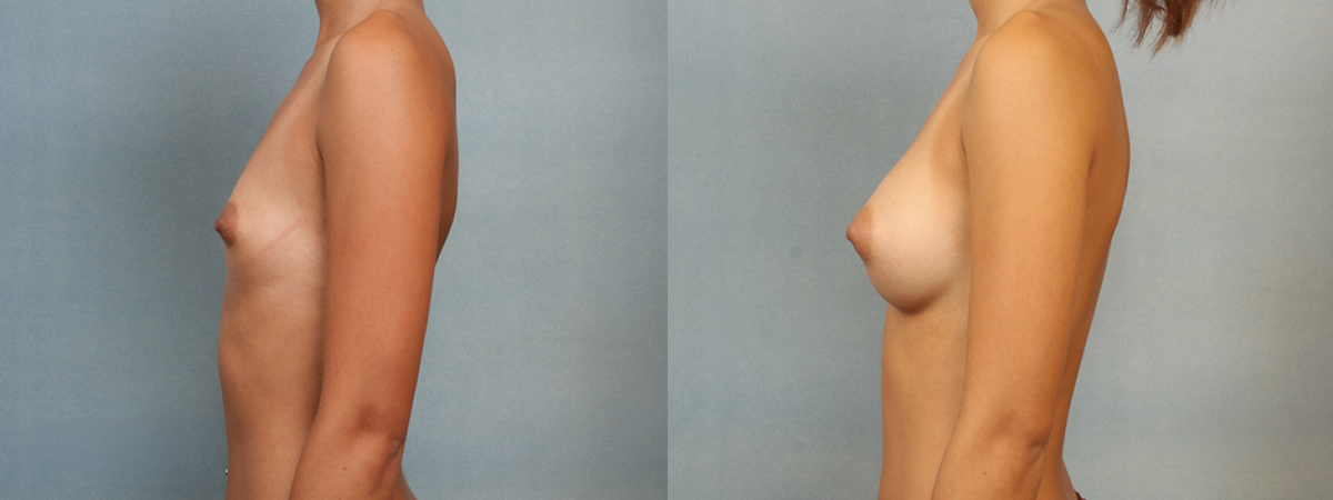 Before and after – Breast Surgery – Female patient, age 20-29 – Image 39