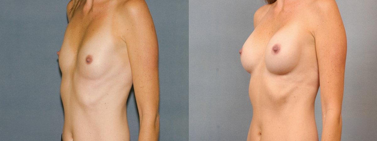 Before and after – Breast Surgery – Female patient, age 40-49 – Image 29