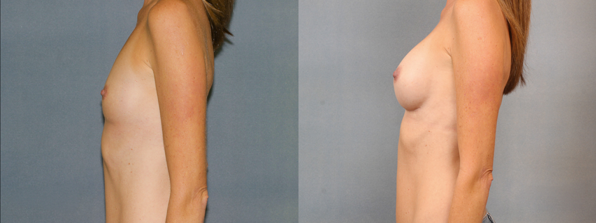 Before and after – Breast Surgery – Female patient, age 40-49 – Image 30