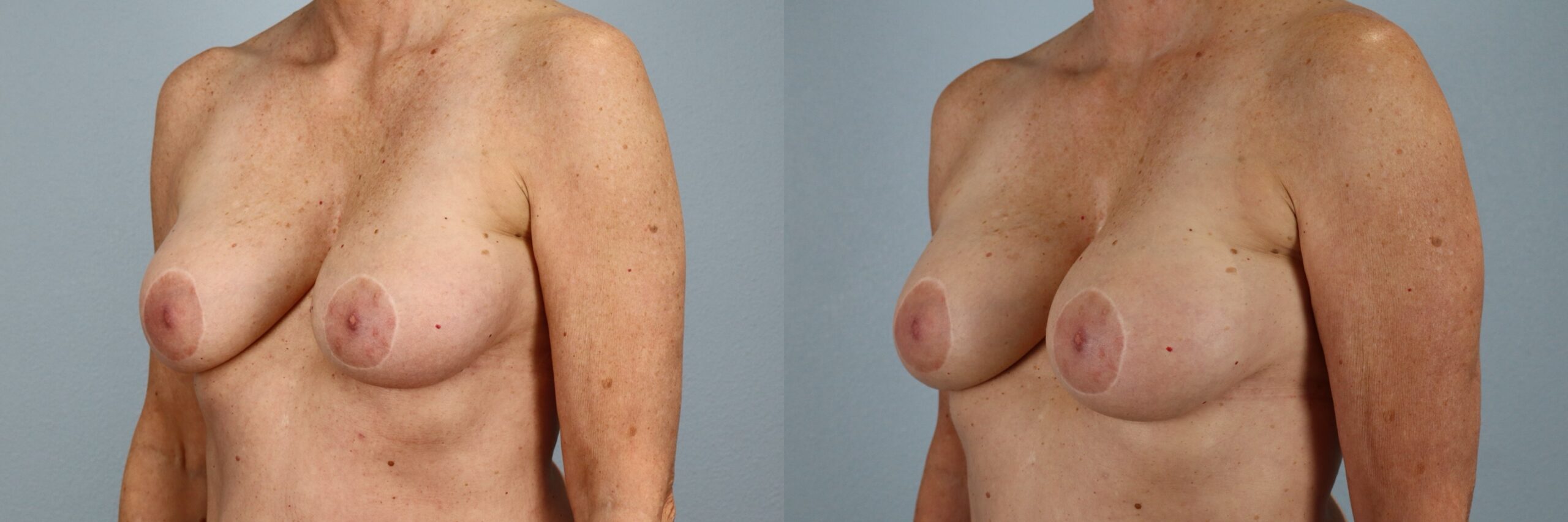 Before and after – Breast Surgery – Female patient, age 60+ – Image 58