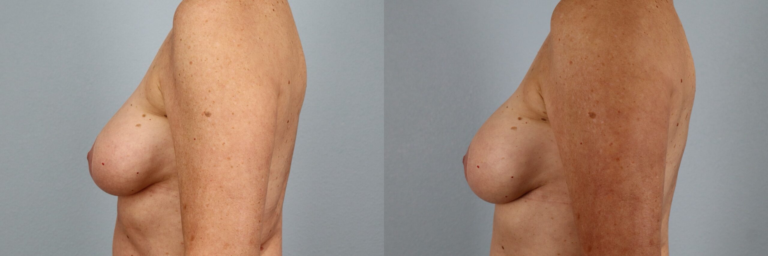 Before and after – Breast Surgery – Female patient, age 60+ – Image 59