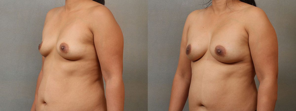 Before and after – Breast Augmentation with Fat Grafting – Female patient, age 40-49 – Image 2