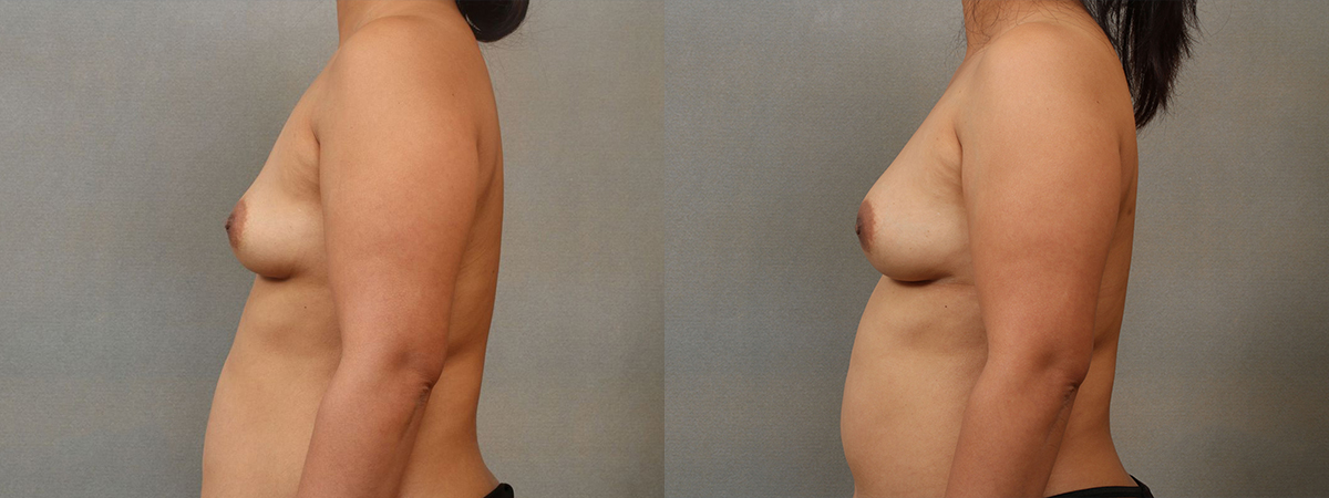 Before and after – Breast Augmentation with Fat Grafting – Female patient, age 40-49 – Image 3