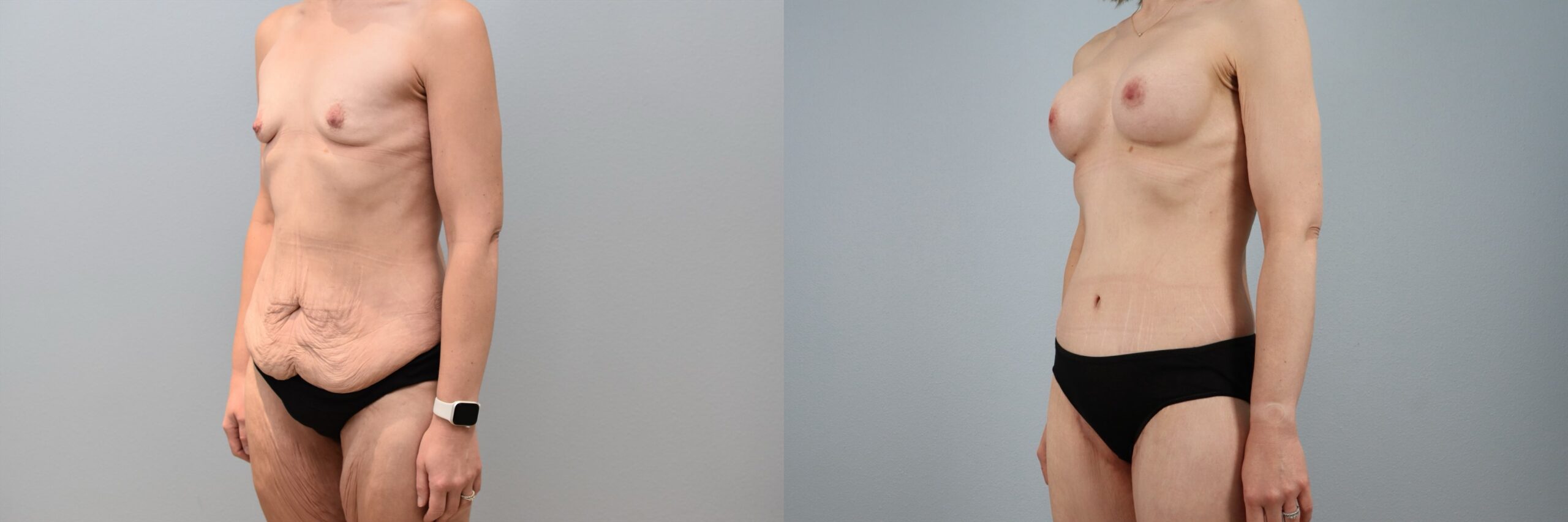 Before and after – Weight Loss Transformation – Female patient, age 40-49 – Image 32