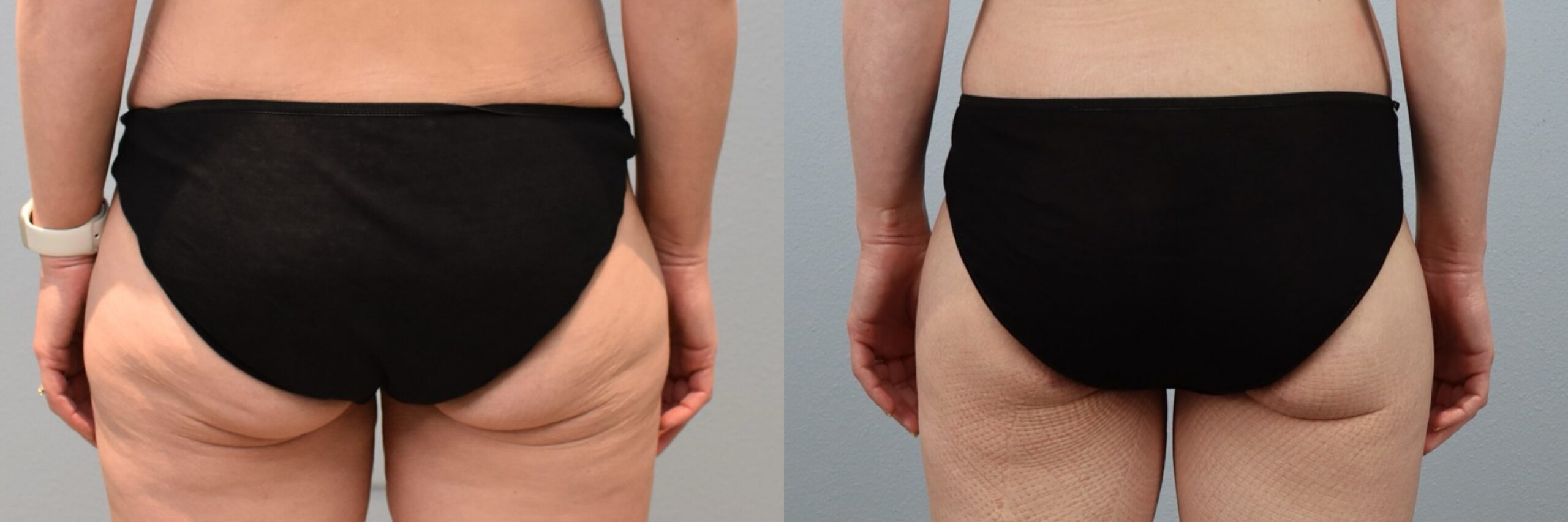 Before and after – Thigh Lift – Female patient, age 40-49 – Image 15