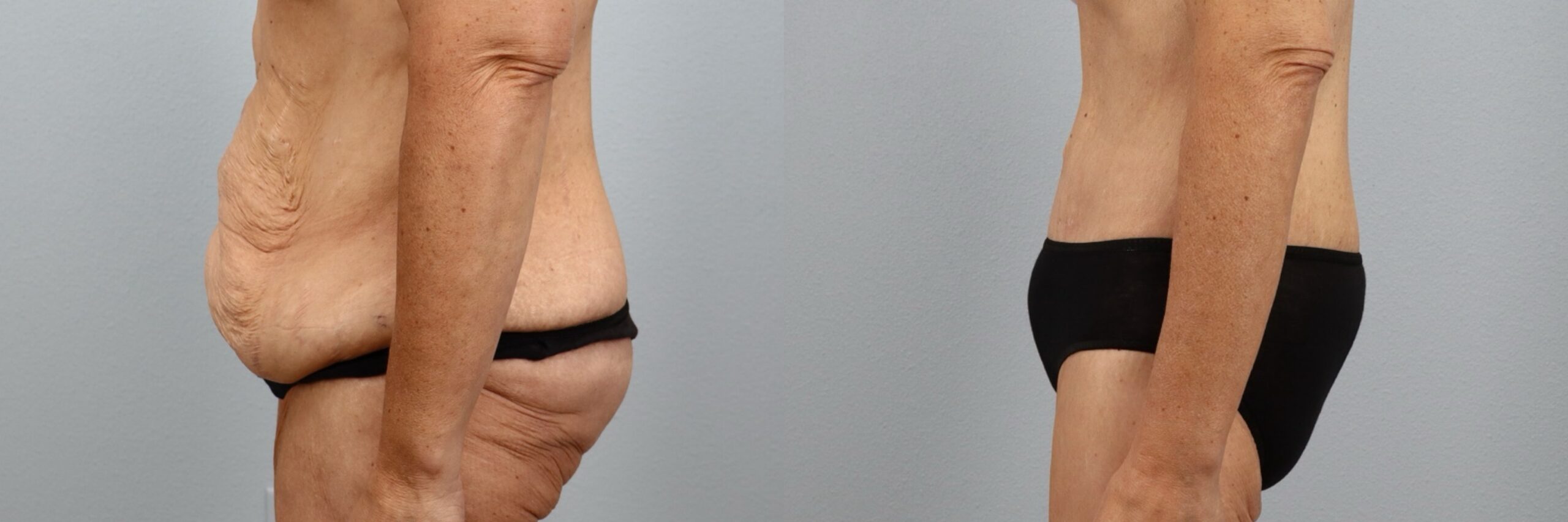 Before and after – Weight Loss Transformation – Female patient, age 50-59 – Image 3