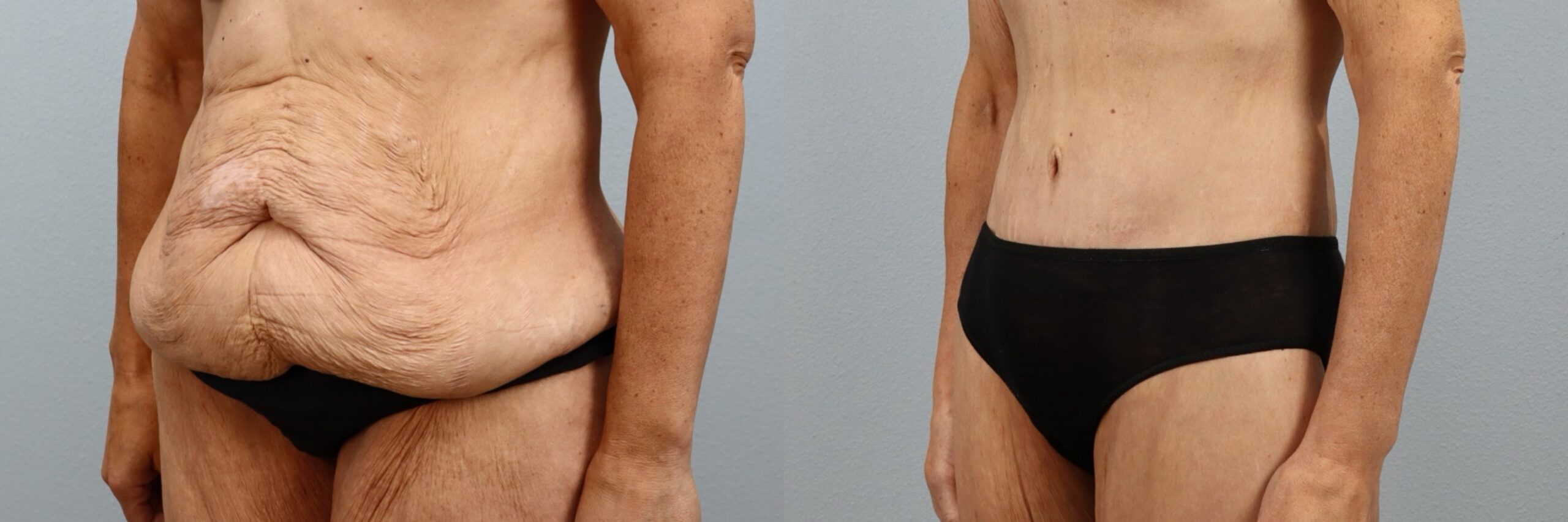 Before and after – Weight Loss Transformation – Female patient, age 50-59 – Image 2