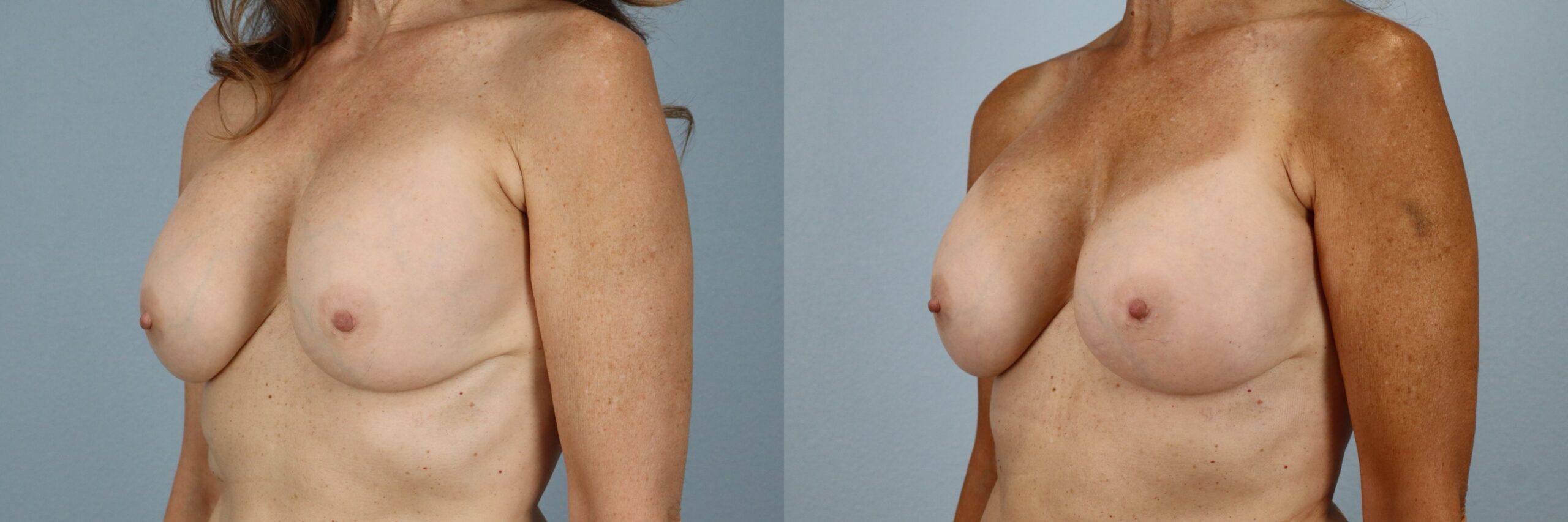 Before and after – Breast Surgery – Female patient, age 60+ – Image 53