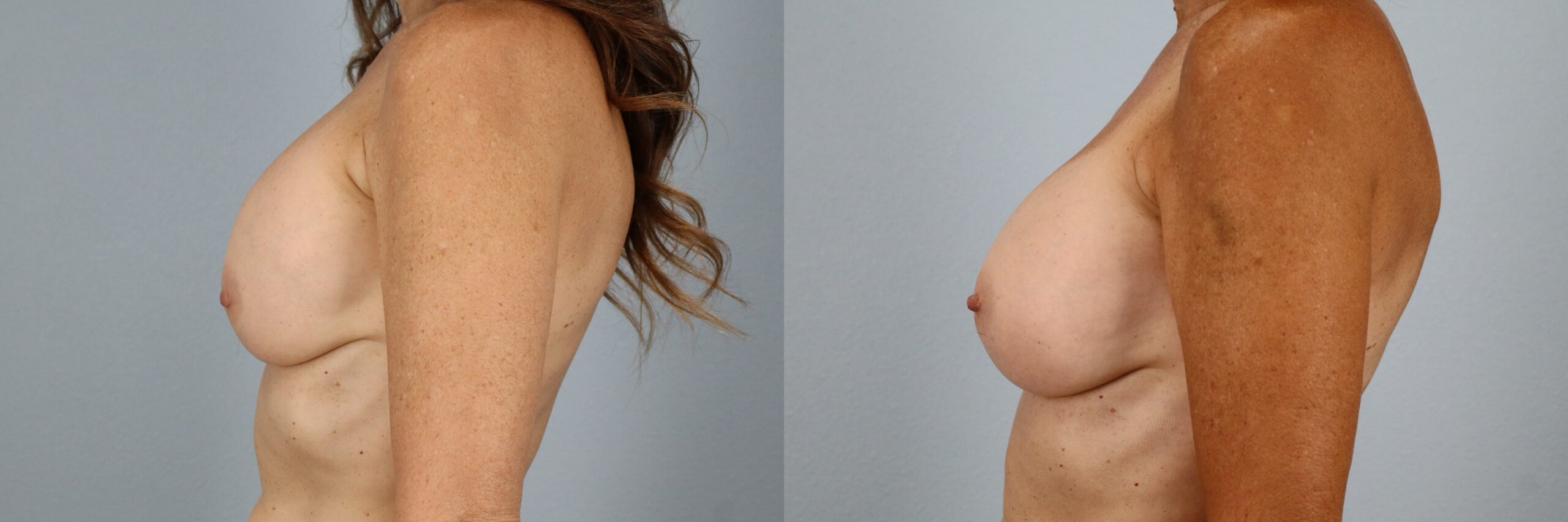 Before and after – Breast Surgery – Female patient, age 60+ – Image 54