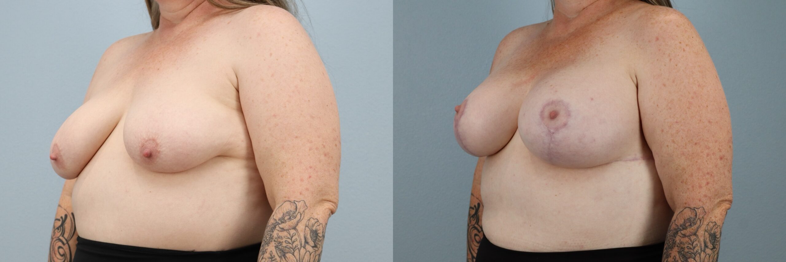 Before and after – Breast Lift With Implants – Female patient, age 50-59 – Image 50