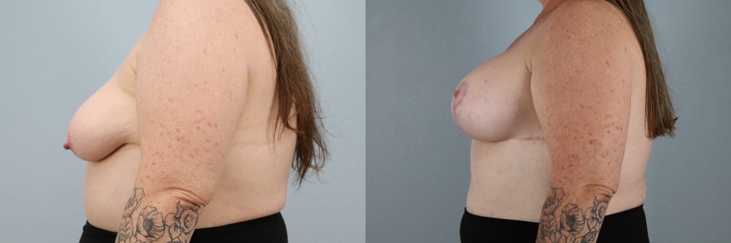 Before and after – Breast Lift With Implants – Female patient, age 50-59 – Image 51