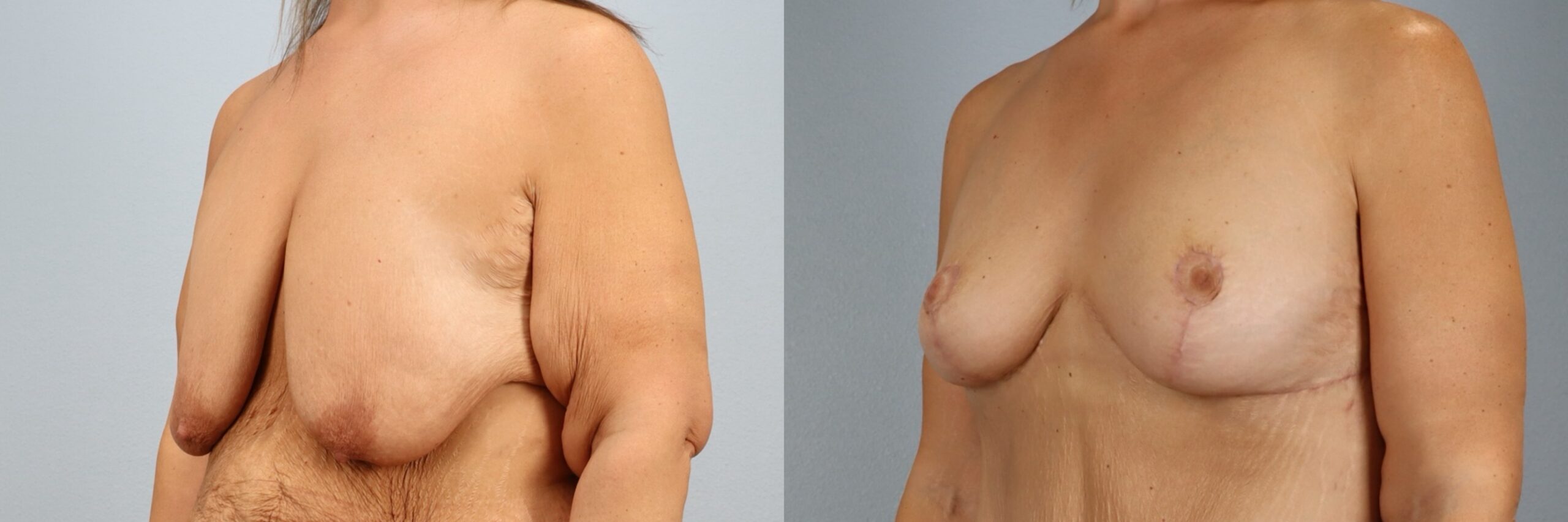 Before and after – Breast Surgery – Female patient, age 40-49 – Image 26
