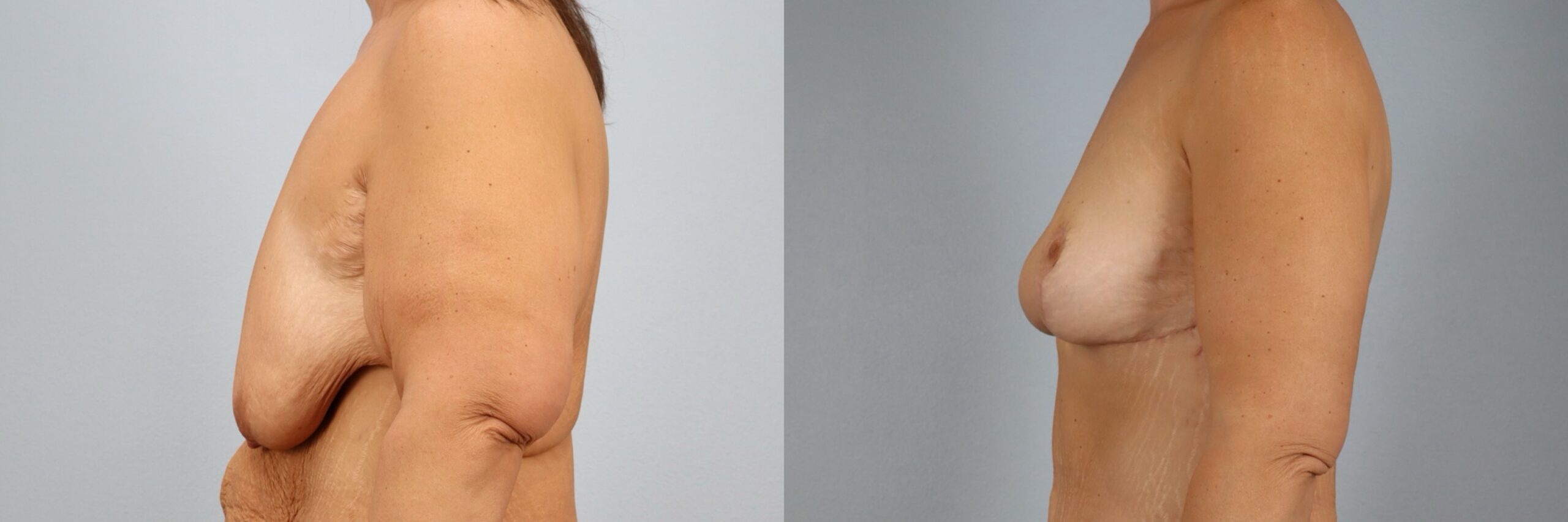 Before and after – Breast Surgery – Female patient, age 40-49 – Image 27