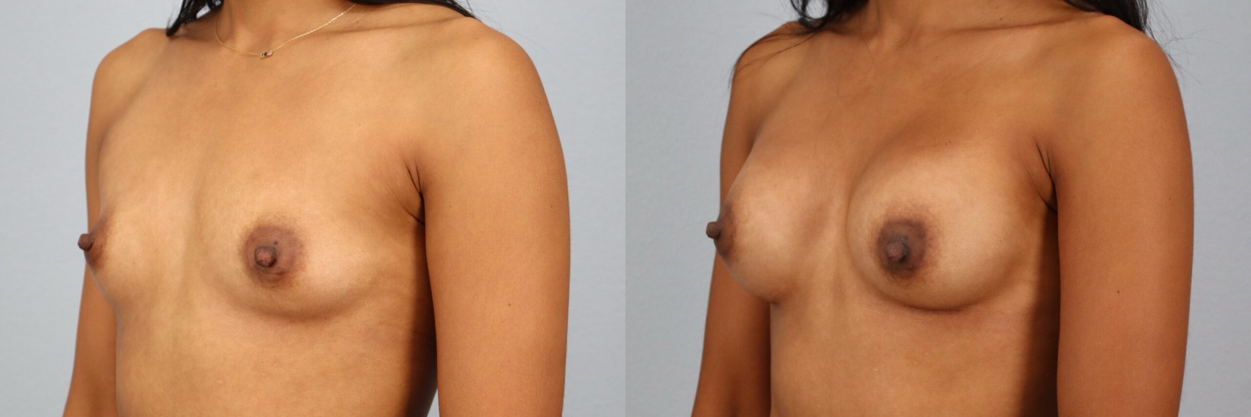 Before and after – Breast Surgery – Female patient, age 30-39 – Image 32