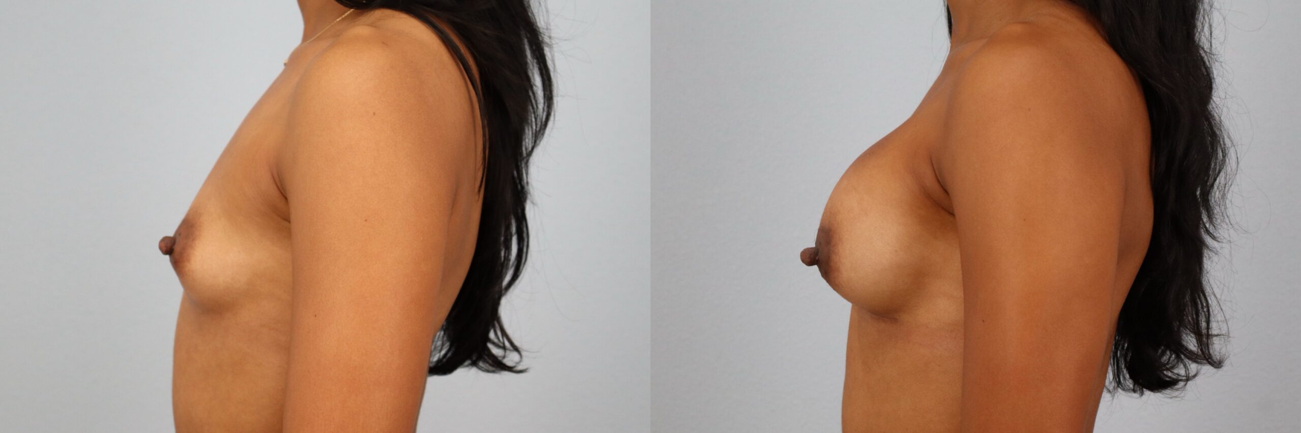 Before and after – Breast Surgery – Female patient, age 30-39 – Image 33