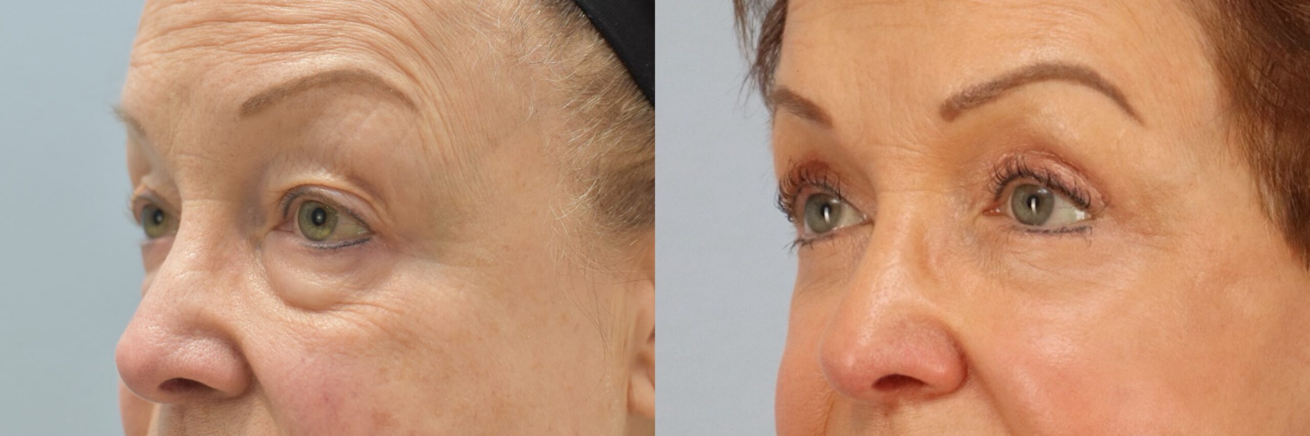 Before and after – Facial Surgery – Female patient, age 60+ – Image 41