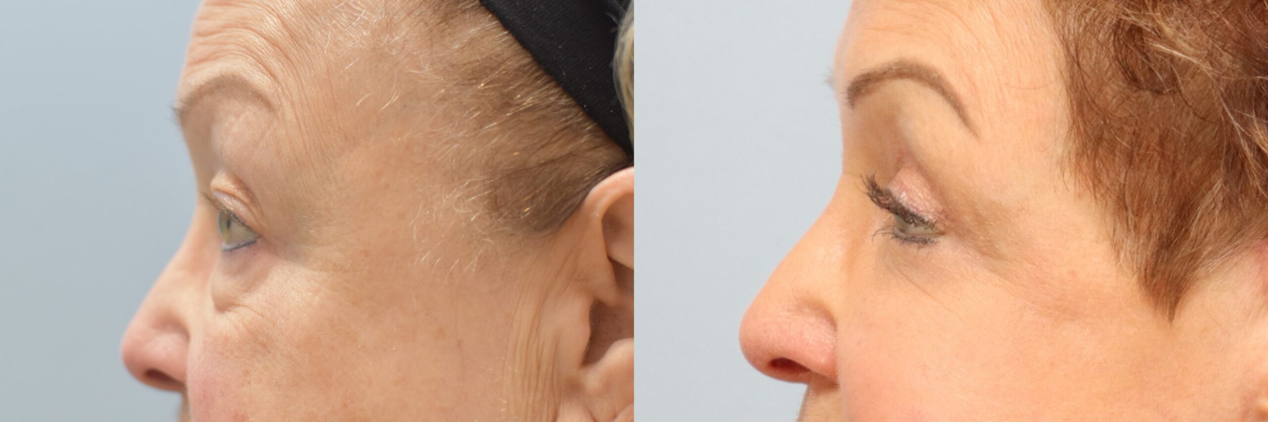 Before and after – Facial Surgery – Female patient, age 60+ – Image 42