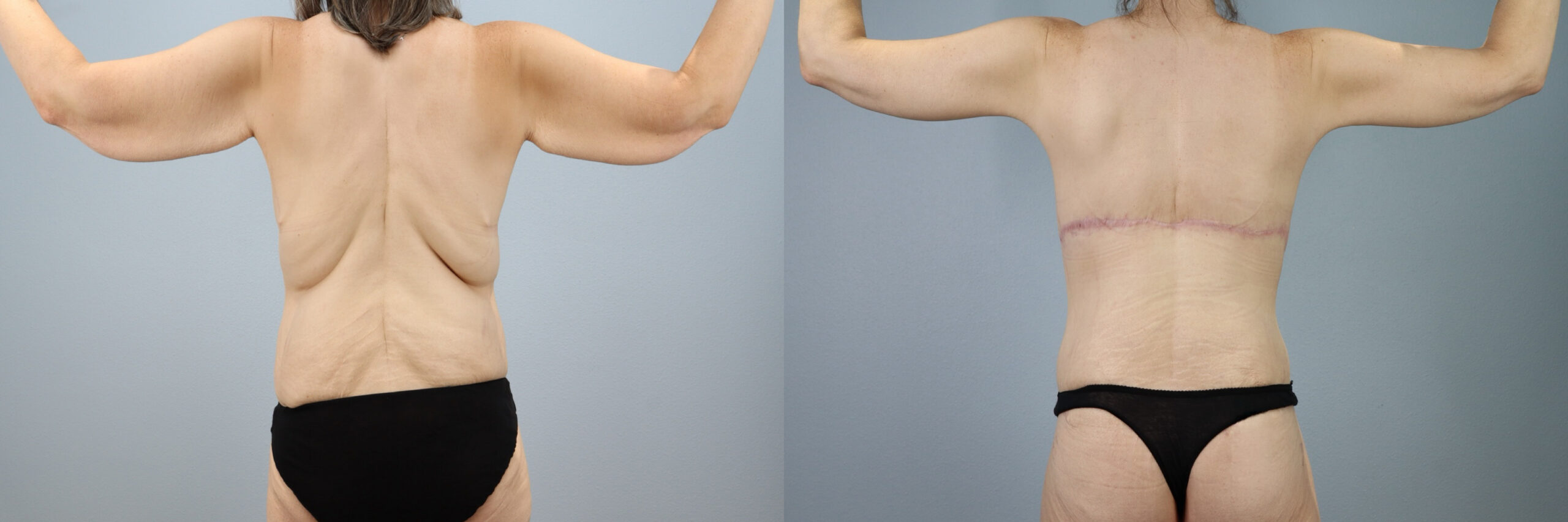 Before and after – Bra Line Back Lift – Female patient, age 40-49 – Image 18