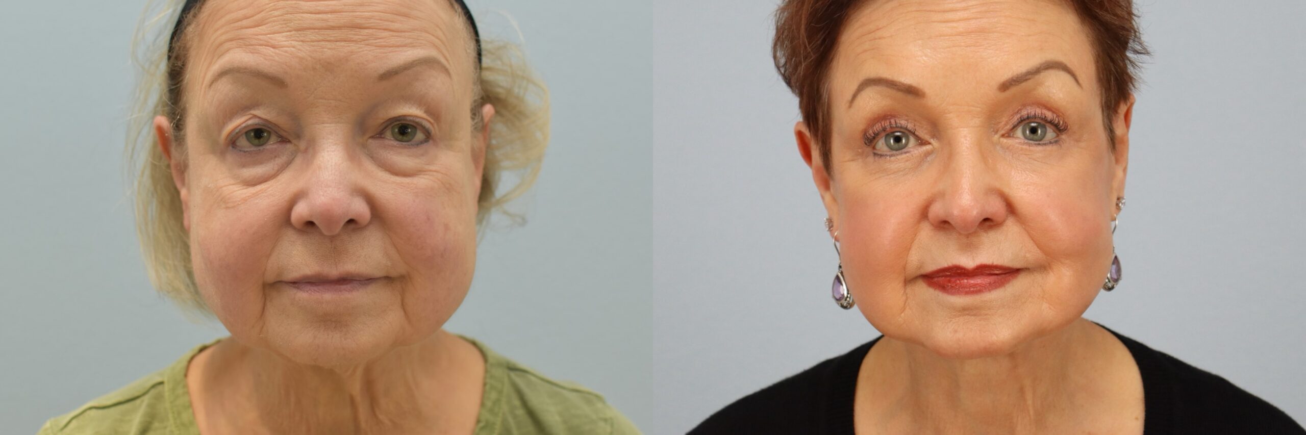 Before and after – Facelift Surgery – Female patient, age 60+ – Image 4