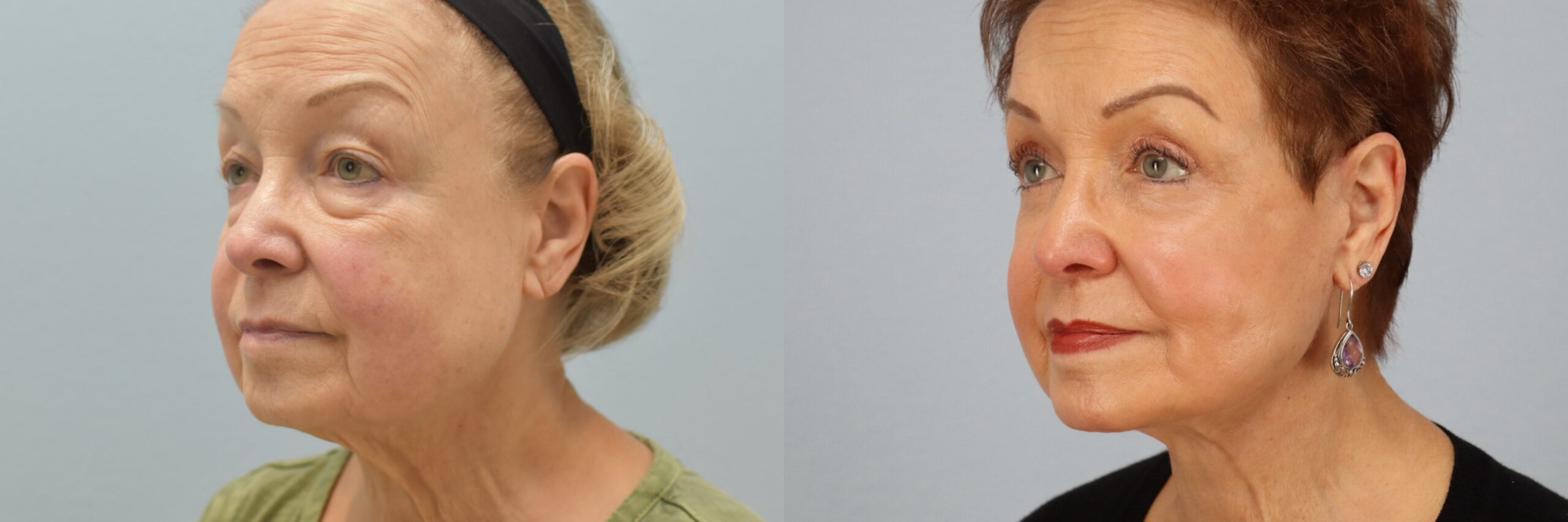 Before and after – Facelift Surgery – Female patient, age 60+ – Image 5