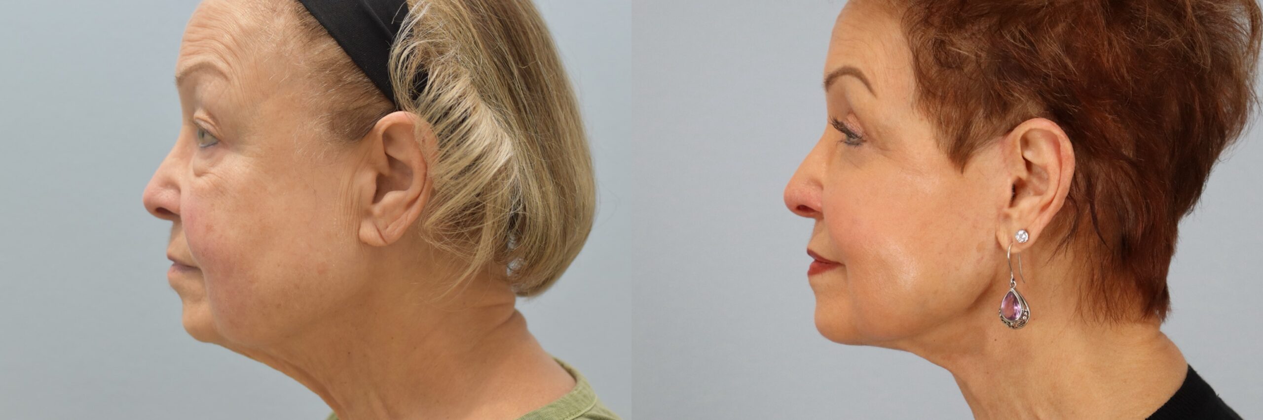 Before and after – Facelift Surgery – Female patient, age 60+ – Image 6