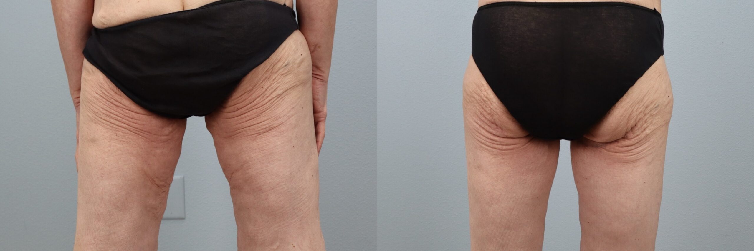 Before and after – Thigh Lift – Female patient, age 50-59 – Image 2