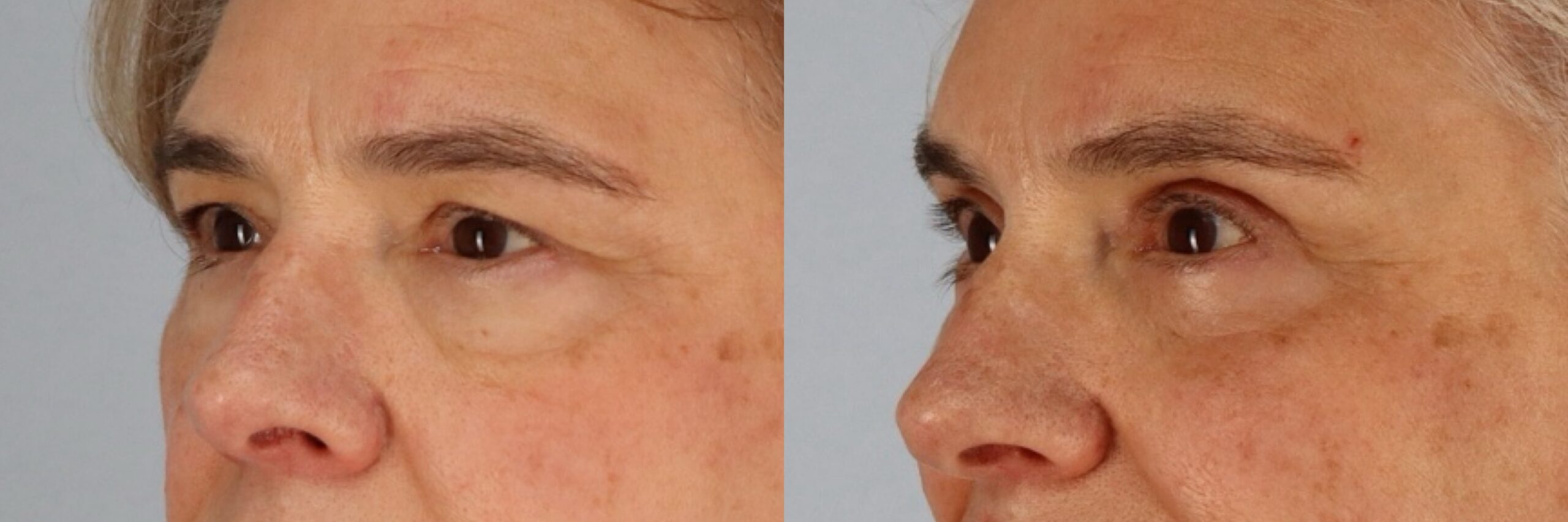 Before and after – Facial Surgery – Female patient, age 60+ – Image 38