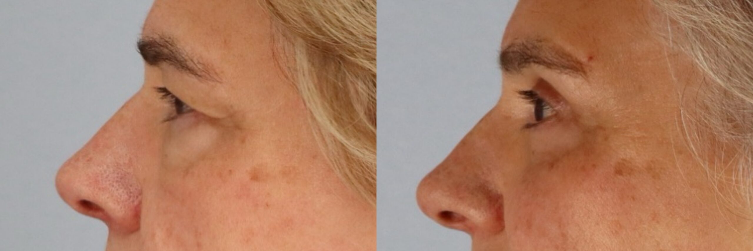 Before and after – Facial Surgery – Female patient, age 60+ – Image 39