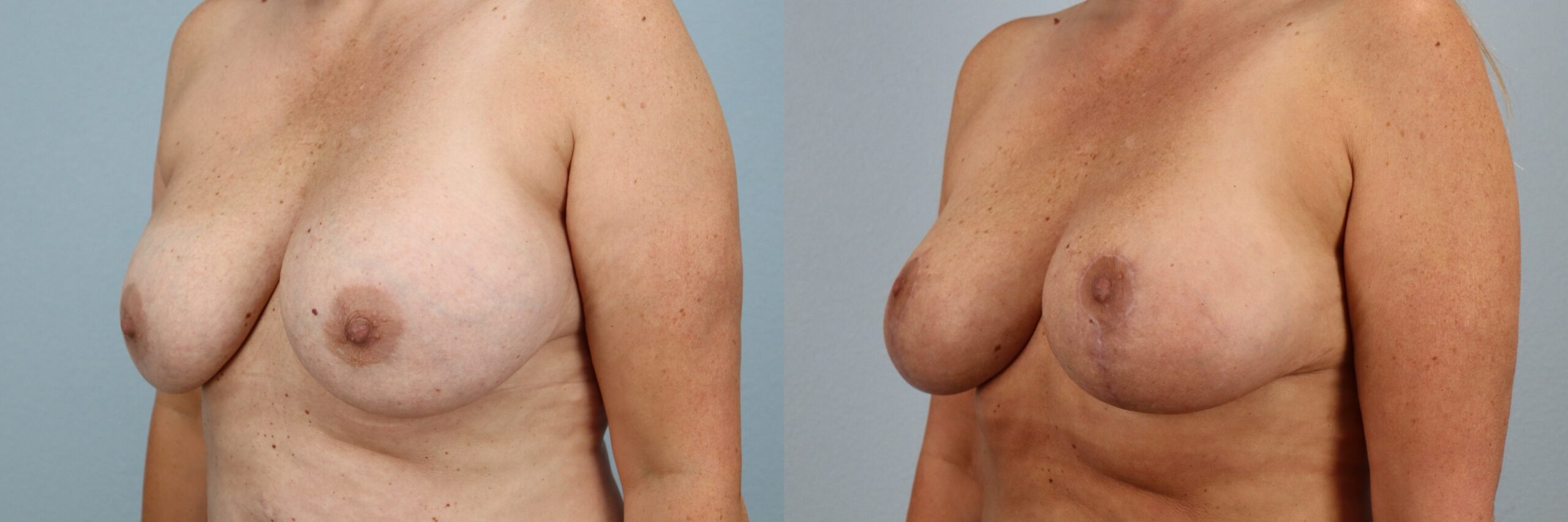 Before and after – Breast Surgery – Female patient, age 50-59 – Image 52