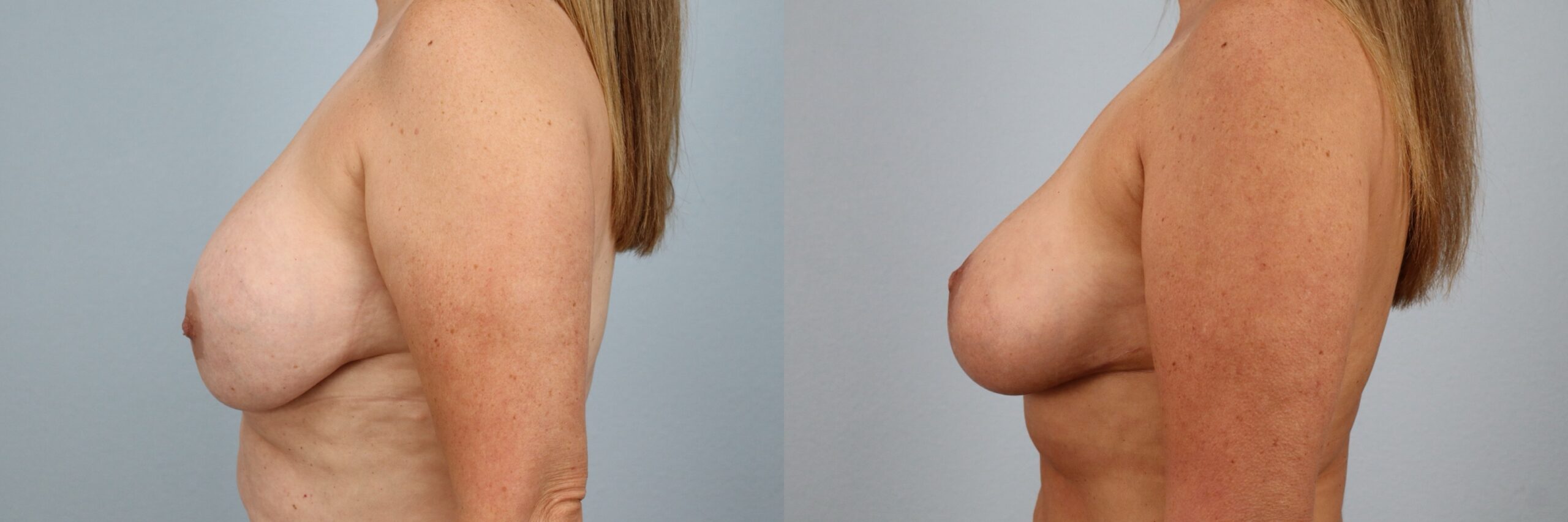 Before and after – Breast Surgery – Female patient, age 50-59 – Image 53