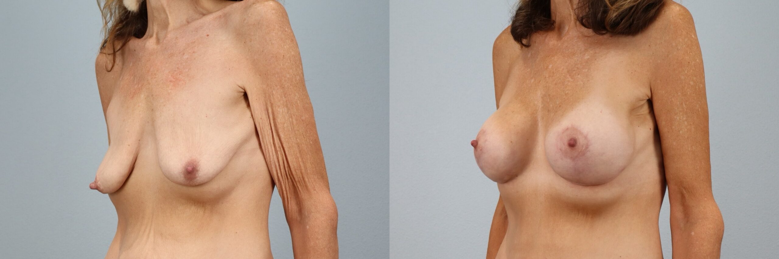 Before and after – Breast Lift With Implants – Female patient, age 50-59 – Image 59