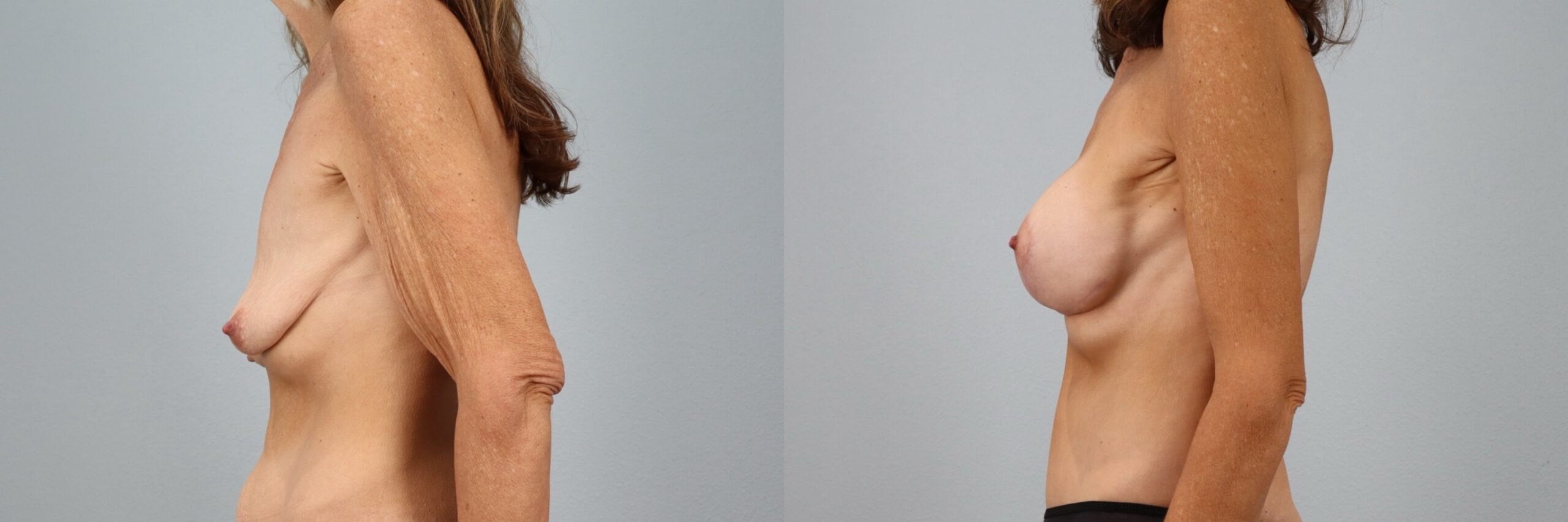 Before and after – Breast Lift With Implants – Female patient, age 50-59 – Image 60